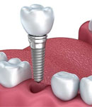 همه چیز درباره ایمپلنت دندان(اشترومن سوئیس) با روکش تمام سرامیک ( CAD-CAM) در  دندانپزشکی دکتر مهدی کریمی