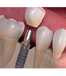عواقب از دست دادن دندان ها