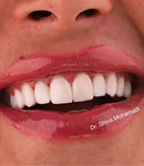 کامپوزیت ونیر دندان تخصصی در  دندانپزشکی دکتر شیوا محمدی
