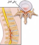 تنگی کانال ‌کمر و گردن، علت اصلی آسیب به اعصاب نخاعی و درمان آن توسط فیزیوتراپی گلچین