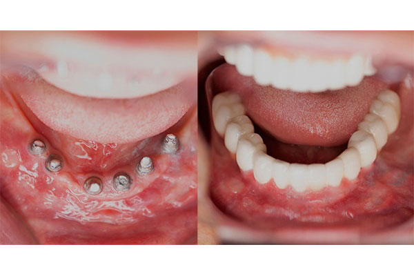 بی هوشی برای ایمپلنت دندان ضروری است؟