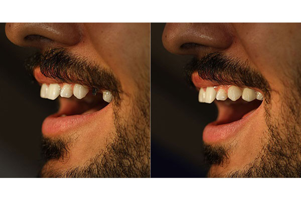 روش انجام پیوند استخوان در دندانپزشکی