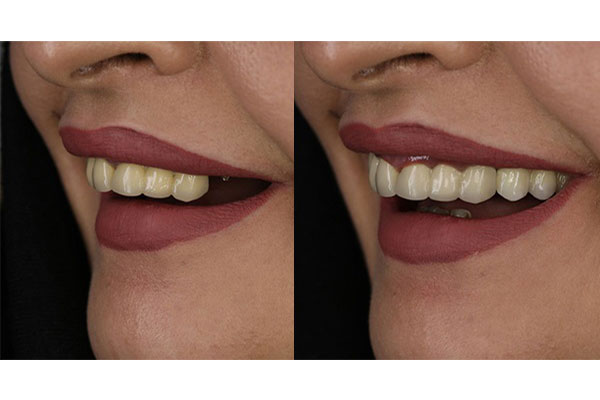 علت استفاده از پیوند استخوان دندان
