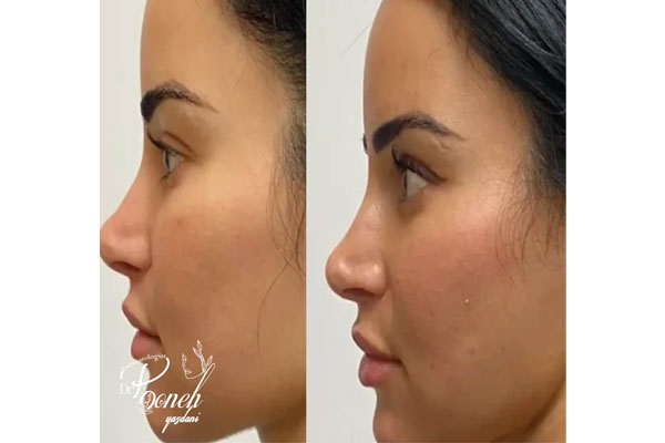 چه کسانی بهترین کاندید لیفت صورت بدون جراحی با لیزر هستند؟