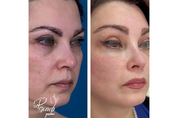 چرا اندولیفت صورت در تهران باید توسط دکتر متخصص انجام شود؟