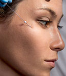 لیفت صورت با نخ کلاژن ساز، روشی موثر برای جوان ‌تر شدن پوست