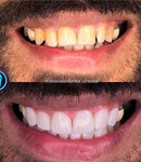 طراحی لبخند دیجیتال و فیسینگ، روشی تضمینی برای داشتن لبخندی زیبا در کلینیک دندانپزشکی نوین تهران