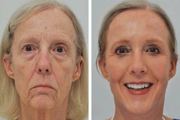 میکرونیدلینگ چیست؟