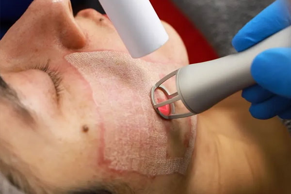 لیزر Co2 فرکشنال چیست؟