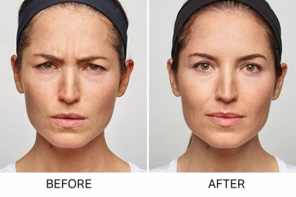 تفاوت بوتاکس و فیلر جوانساز در چیست؟