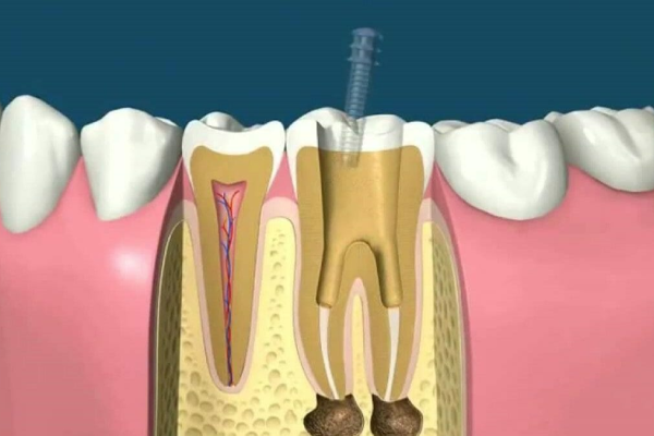 مراحل عصب کشی دندان چیست؟