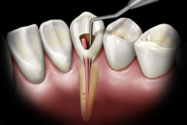 انجام تخصصی عصب کشی توسط دکتر ابوالحسنی
