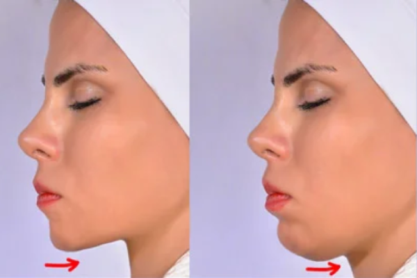 مزایای لیپوساکشن غبغب با دستگاه بادی جت