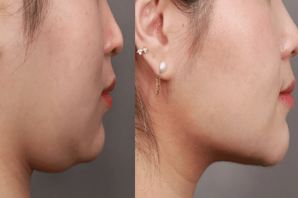 نکات مهم در استفاده از دستگاه بادی جت برای لیپوساکشن غبغب