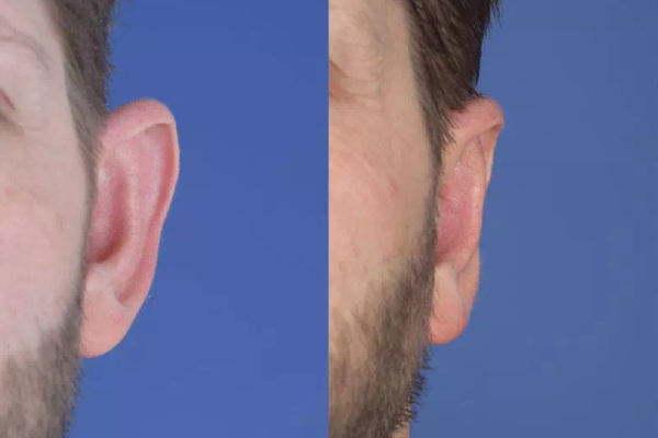 مراقبت های اساسی بعد از انجام جراحی زیبایی گوش