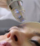 بررسی علمی و کاربردهای پلاسماآر اف فرکشنال در درمان مشکلات پوستی