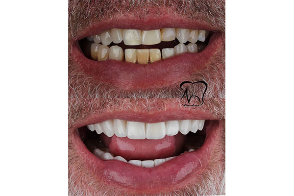 کامپوزیت و لمینیت تفاوتشون در چیست؟