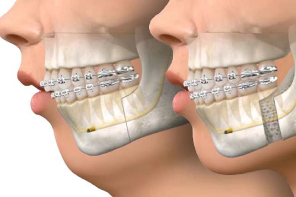 روشهای درمان اوربایت بدون جراحی توسط دکتر حامد محمود هاشمی