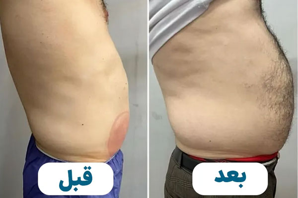 اقدامات لازم قبل و بعد از کرایولیپولیز