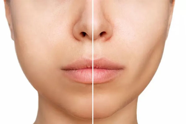 مزایای جراحی بوکال فت