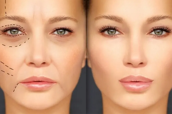 عوارض احتمالی جراحی توتال فیس