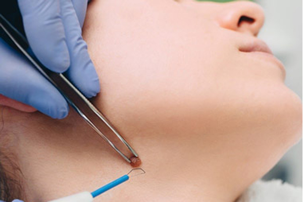 انواع خالبرداری توسط پزشک