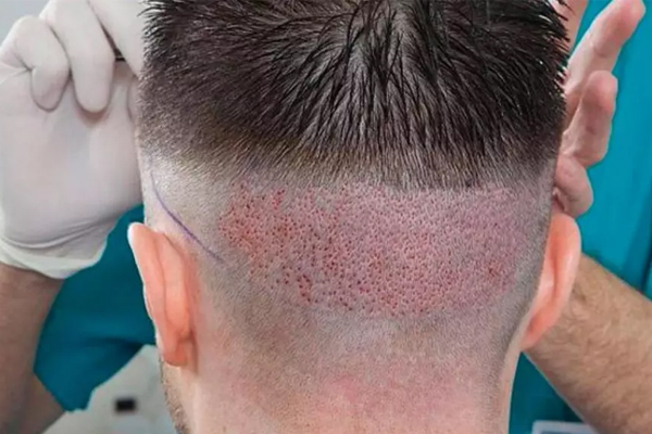 مراقبت‌های قبل از کاشت مو