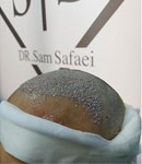 کاشت مو به روش‌ های نوین و تخصصی توسط دکتر سام صفایی