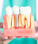 ایمپلنت های دندانی اوردنچر چیست؟دكتر علی شجاعی فر 