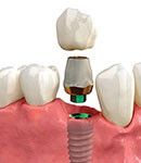 آشنایی با ایمپلنت اقساطی بلند مدت در دندانپزشکی آدرینا