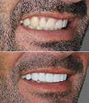 تفاوت کامپوزیت و لمینیت در دندانپزشکی آدرینا؛ کدام بهتر است؟