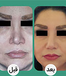  رسیدن به ظاهر دلخواه با ترمیم بینی عمل شده توسط دکتر مجید لاهوتی