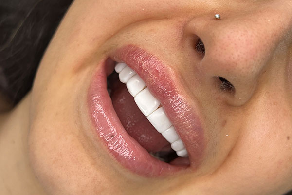 کامپوزیت بدون تراش در تهرانپارس