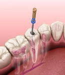 عصب کشی با بهترین دستگاه روتاری در دندانپزشکی دکتر بیتا مدبر