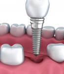 ایمپلنت دندان برند اشترومن سوئیس، بهترین گزینه برای جایگزینی دندان‌های از دست رفته در دندانپزشکی دکتر بیتا مدبر