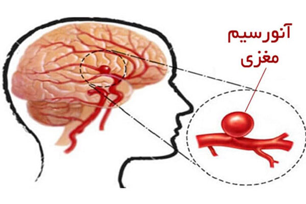 آنوریسم مغزی چیست