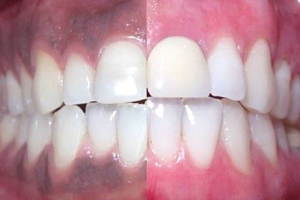 روشهای درمان سیاهی لثه ناشی از سیگار