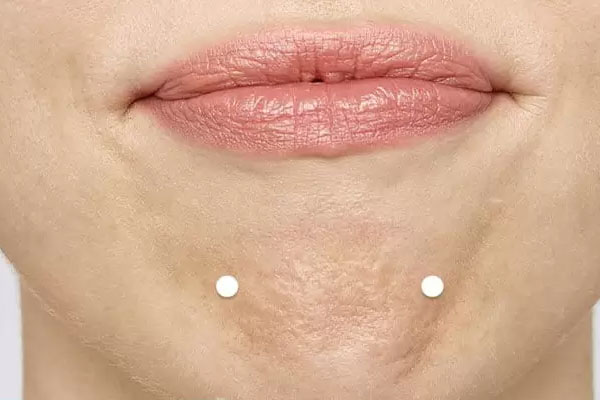 مزایای صاف کردن چانه سنگ فرشی