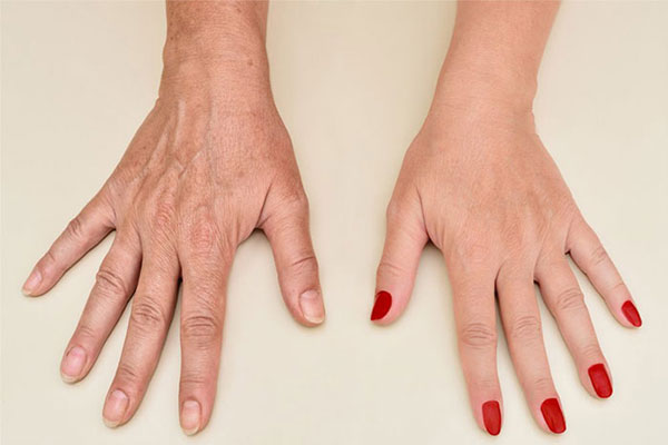 چرا مزوتراپی برای جوانسازی دست و پا مناسب است؟