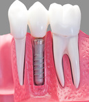 تفاوت پروتز ثابت و متحرک دندان در چیست؟ دکتر فریبا فرهنگ