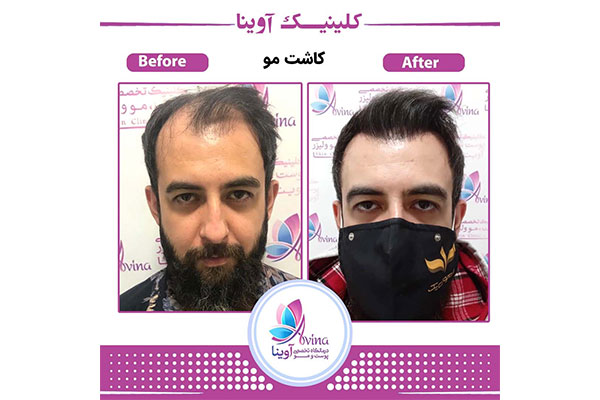 کاشت مو طبیعی با تراکم بالا در ونک
