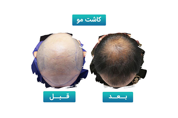 کاشت و پیوند موی طبیعی سر