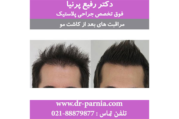 کاشت مو طبیعی با تراکم بالا در جردن