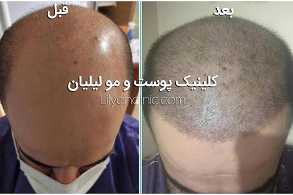 هزینه کاشت موی طبیعی در سال 1402