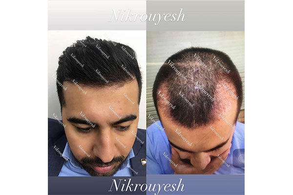 بهترین کلینیک برای کاشت مو طبیعی در تهران