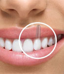 ایمپلنت دندان جلو چگونه انجام می شود؟