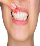 درمان بیماری های لثه در دندانپزشکی حکیمان