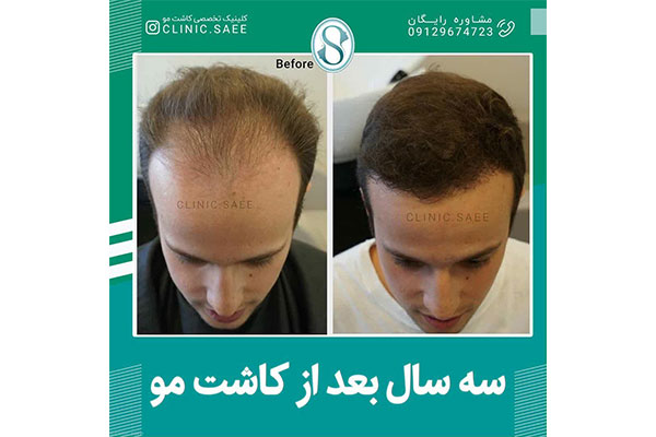 جدیدترین روش کاشت مو در جهان