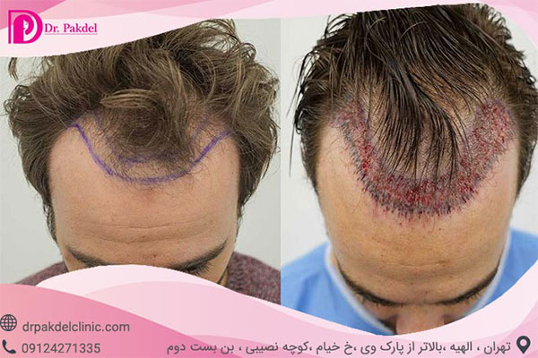 کاشت مو پر تراکم در شمال تهران