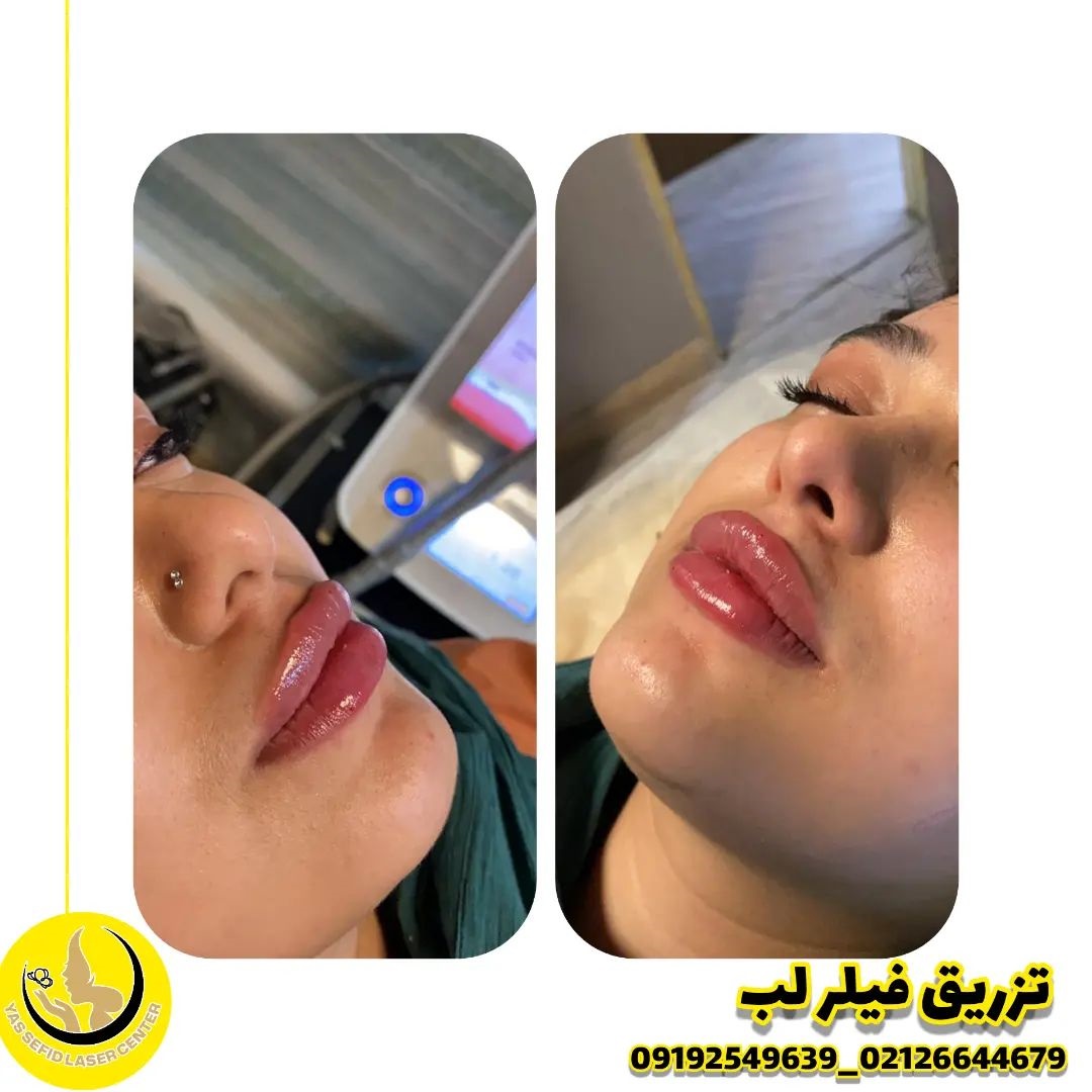 فیلر لب روسی در شریعتی